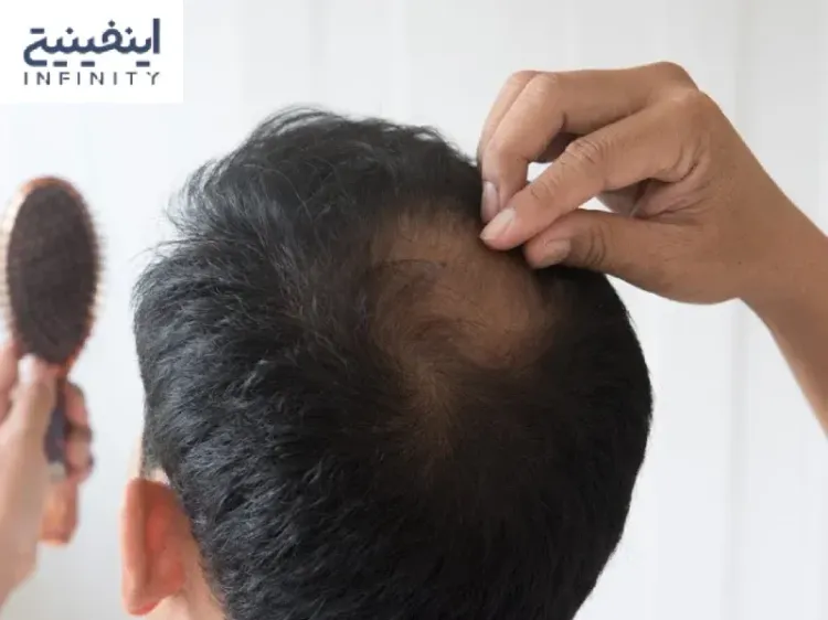 آیا درمان قطعی برای ریزش مو سکه‌ای(آلوپسی آره‌آتا) وجود دارد؟